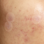 Patch Me Up Waterproof Pimple Patches - Image 7
