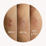 Patch Me Up Waterproof Pimple Patches - Image 5